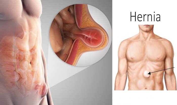 Hernia: Causes, Symptoms, Treatments, and Prevention