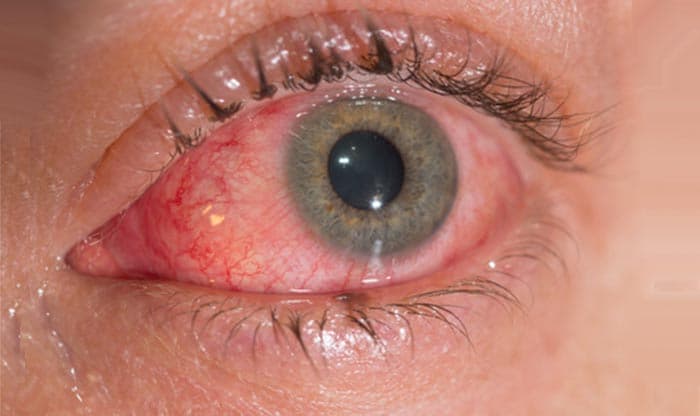 Conjunctivitis (Pink Eye): Causes, Symptoms and Treatments