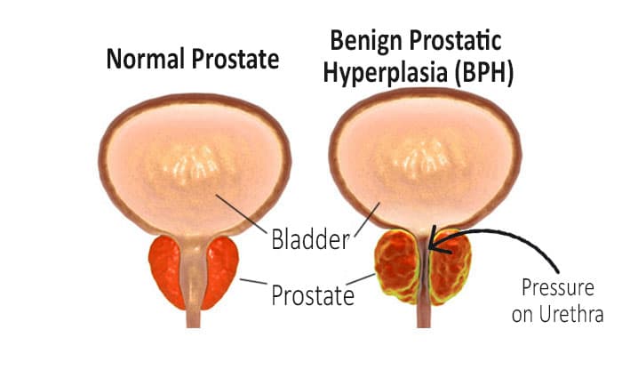 Benign Prostatic Hyperplasia (BPH): Causes, Symptoms, Diagnosis, and Treatment