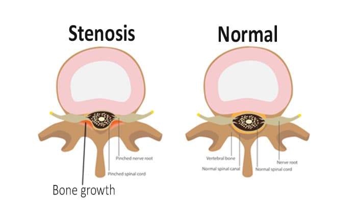 Spinal Stenosis: Symptoms, Causes, Diagnosis, Treatment