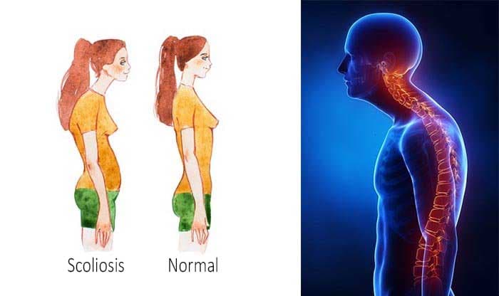 Scoliosis: Types, Causes, Symptoms, Diagnosis, Prevention, and Treatment