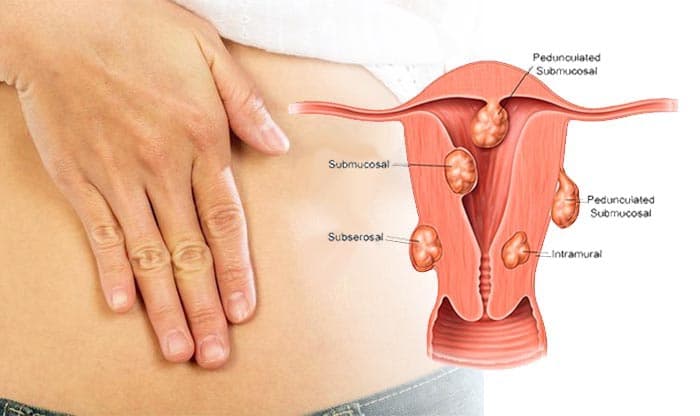Fibroids: Types, Causes, Symptoms, and Treatments