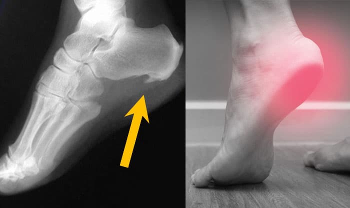 Calcaneal Spur – Causes, Symptoms, Treatment, Prevention, and Natural Remedies