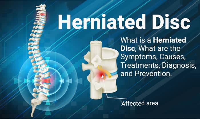 Herniated Disc – Symptoms, Causes, and Treatment