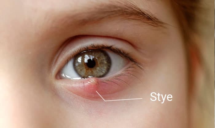 Eye Stye – Causes, Symptoms, Treatment and Prevention