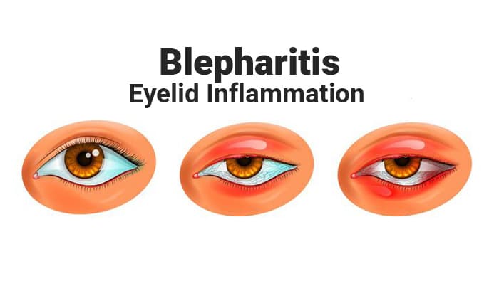 Blepharitis – Causes, Symptoms, Diagnosis, Treatment and Prevention
