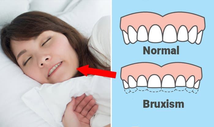 Bruxism – Symptoms, Causes, Diagnosis, Treatments