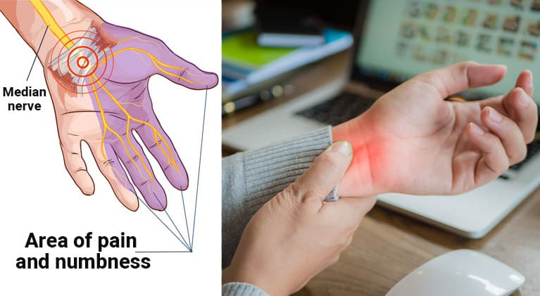 Carpal Tunnel Syndrome – Causes, Symptoms, Diagnosis, Treatment and Prevention