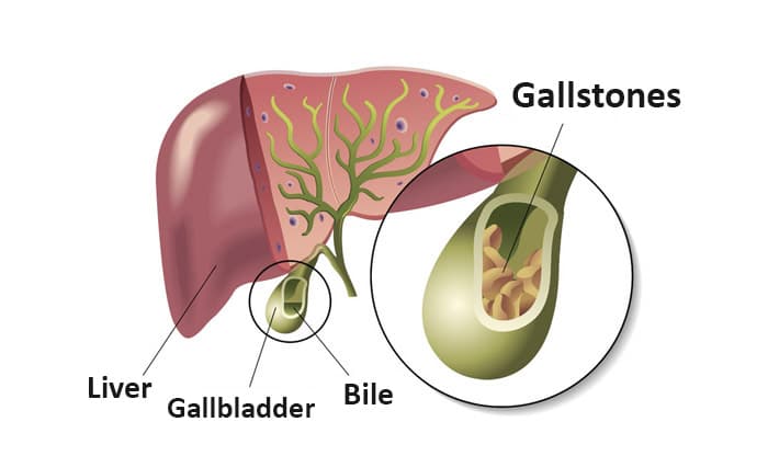 Gallstones – Types, Causes, Diagnosis, Treatment, Complications and Prevention