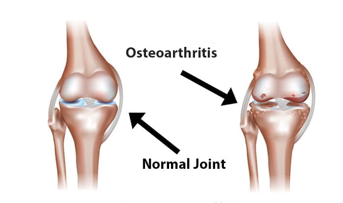 Osteoarthritis: Causes, Symptoms, Treatment, Prevention and Much More