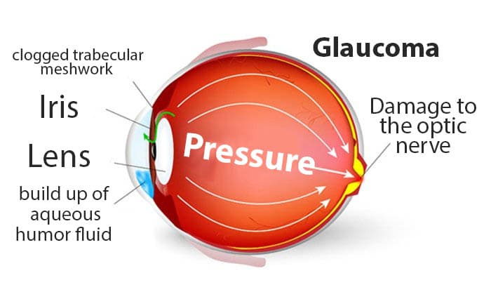 Glaucoma: Causes, Signs and Symptoms, Treatments