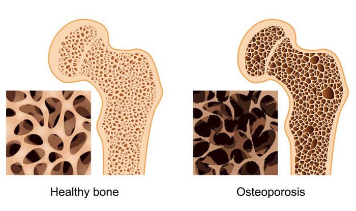 Osteoporosis: Causes, Symptoms, Treatment, Prevention