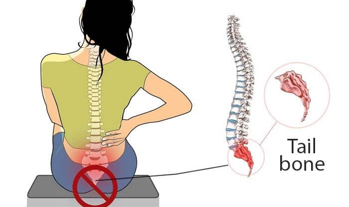 Coccydynia (Tailbone Pain) Causes, Diagnosis, Pain Relief and Prevention