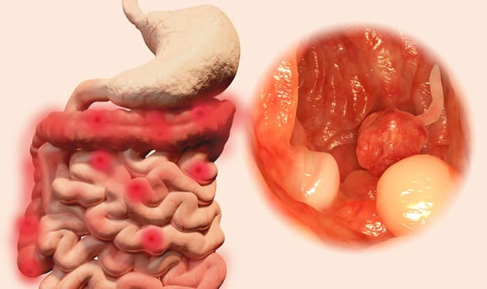 Bowel Polyps – Causes, Symptoms, and Treatments