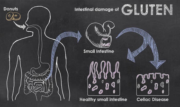 Celiac Disease: Causes, Symptoms, Diagnosis, Treatment, and Prevention