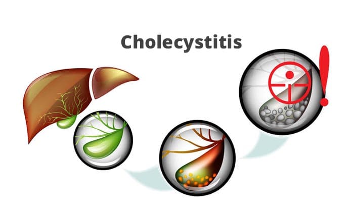 Cholecystitis – Causes, Symptoms and Treatments