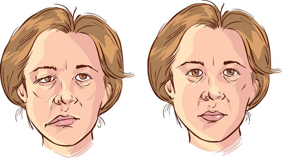 Bell’s Palsy – Symptoms, Causes, Diagnosis, and Treatment