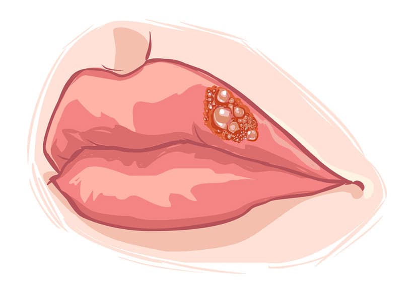 Herpes Simplex – Causes, Symptoms, Treatment, and Prevention