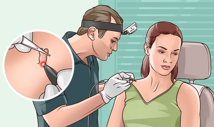 Skin Tags – What Are They? Causes and Treatments