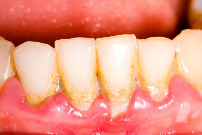 Beat the Bacteria: How to Prevent Plaque and Tartar for Oral Health