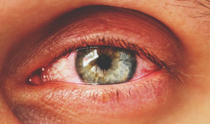 Understanding Watery Eyes: 11 Different Reasons